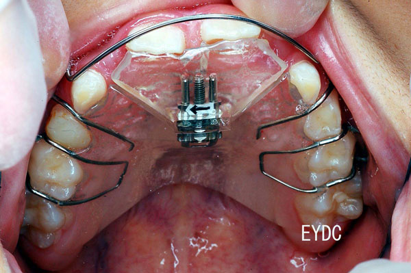 前歯をネジの力で押し出して、角度を変える取り外し式の装置に変更