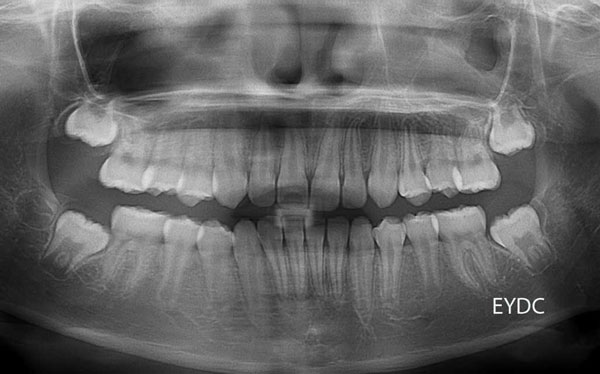 被曝量のきわめて少ないデジタルレントゲンで、歯の生える状況を定期的に観察していきます