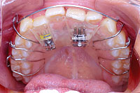 プレート状の入れ歯のような装置
